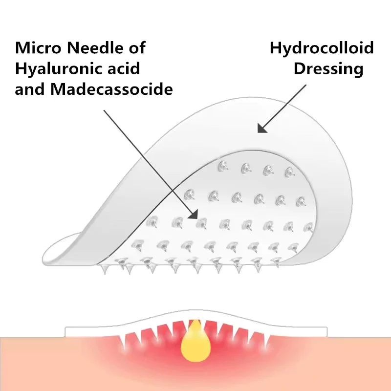 Waterproof Hydrocolloid Spot Patch with Tea Tree Oil — Invisible Acne Fix - Image 4